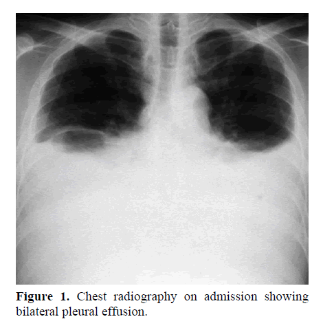 pancreas-bilateral-pleural-effusion