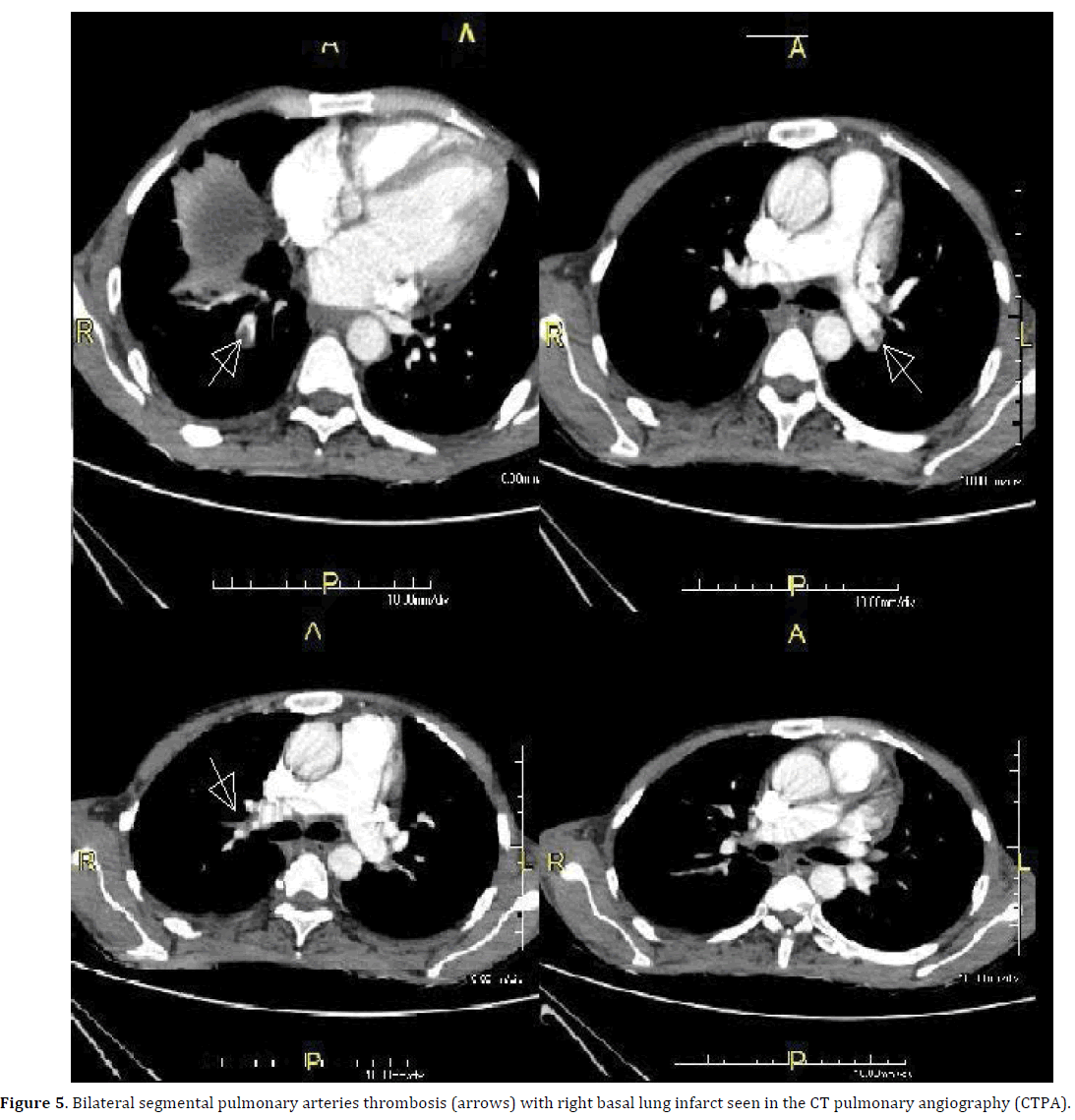 pancreas-bilateral-segmental-pulmonary