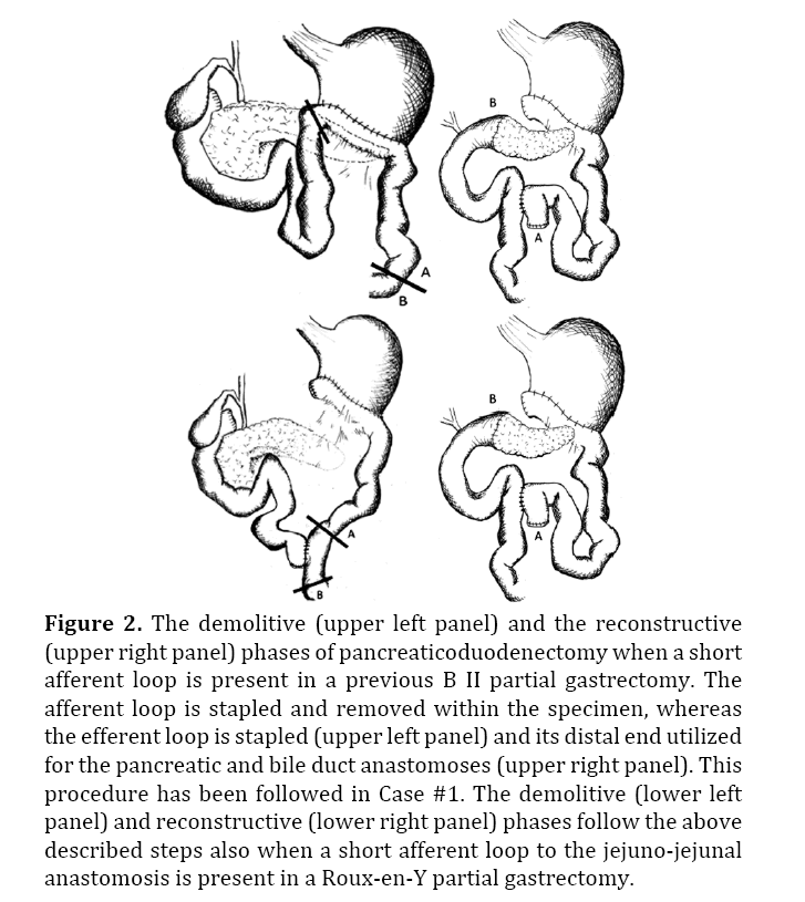 pancreas-bile-duct-anastomoses