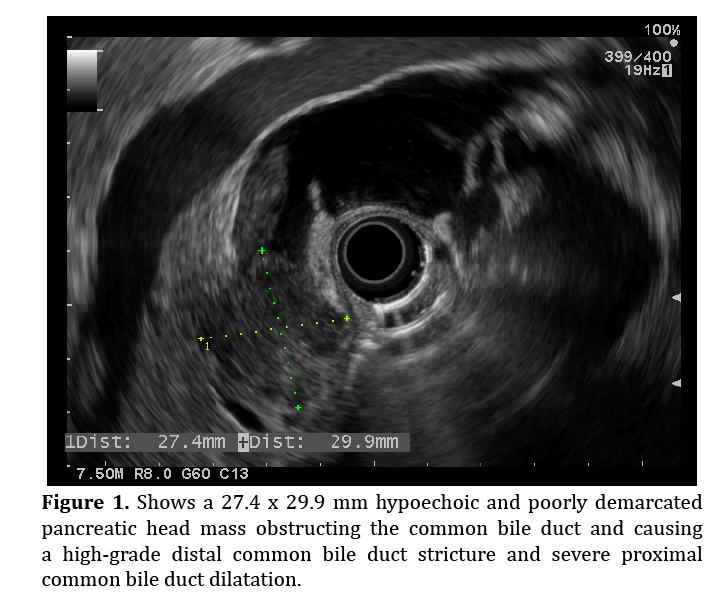 pancreas-bile-duct-dilatation