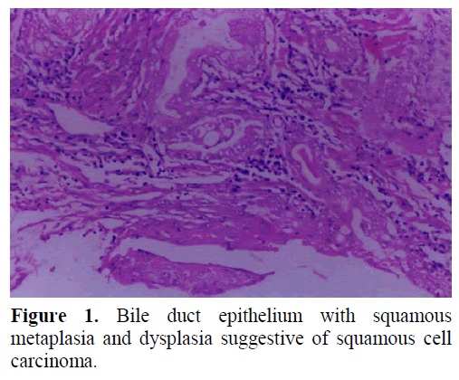 pancreas-bile-duct-epithelium-dysplasia