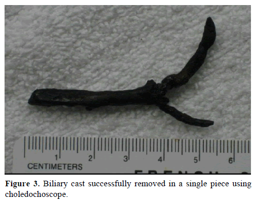 pancreas-biliary-cast-successfully