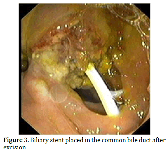 pancreas-biliary-common-bile-duct