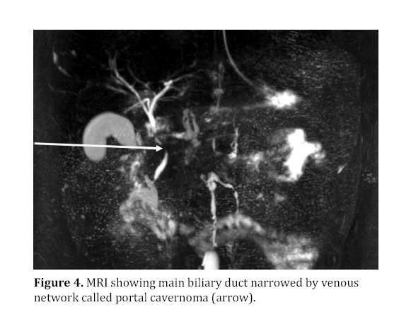 pancreas-biliary-duct-narrowed