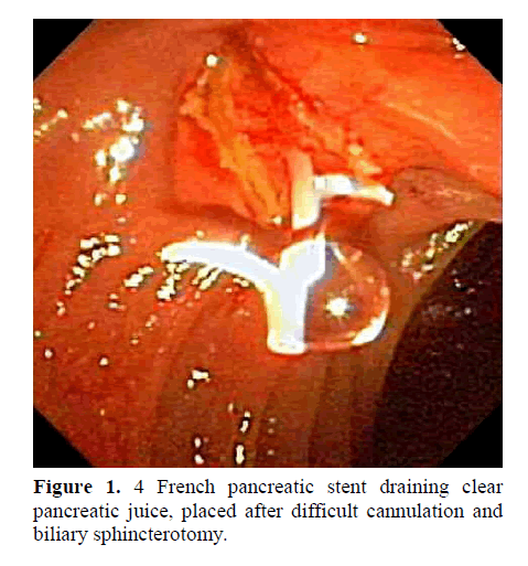 pancreas-biliary-sphincterotomy