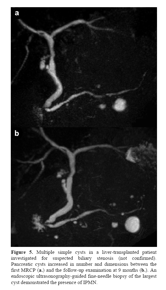 pancreas-biliary-stenosis