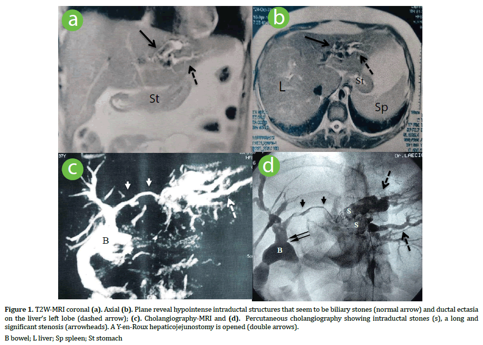 pancreas-biliary-stones