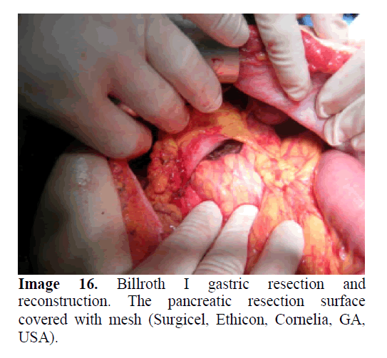 pancreas-billroth-I-gastric-resection