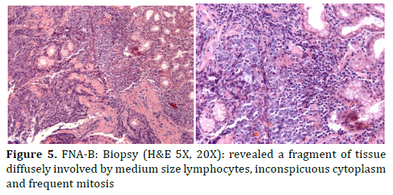 pancreas-biopsy-fragment-fragment