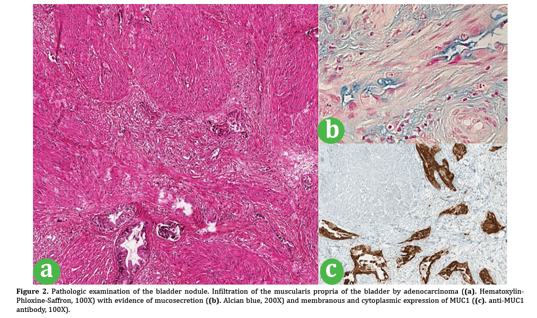 pancreas-bladder