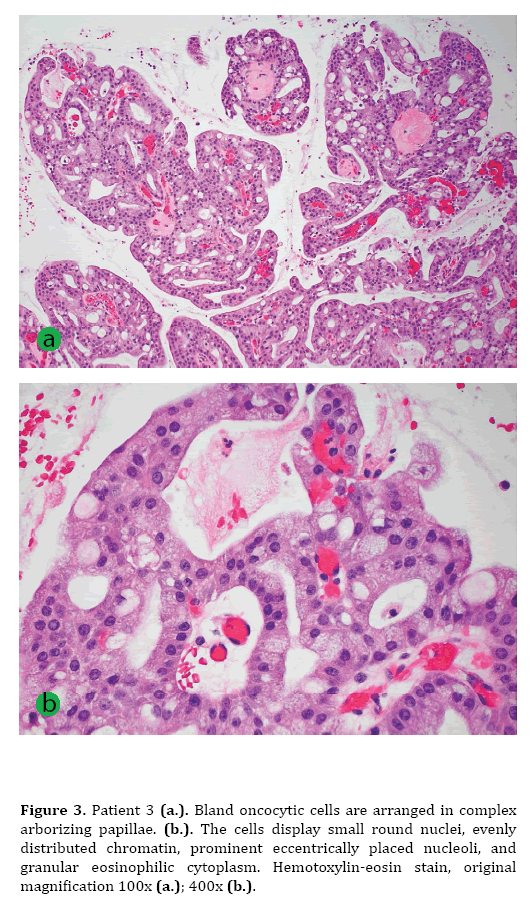 pancreas-bland-oncocytic-cells