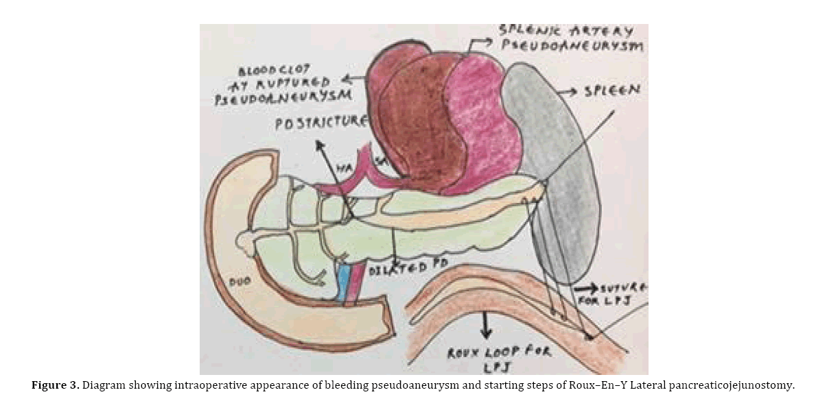 pancreas-bleeding-pseudoaneurysm