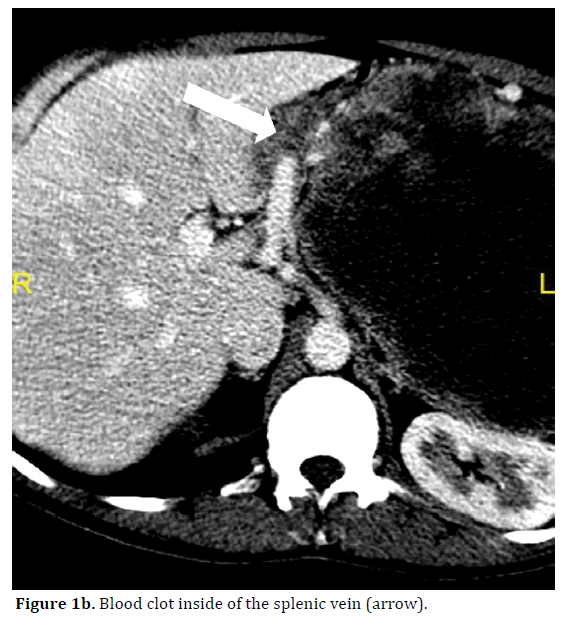 pancreas-blood-clot-splenic