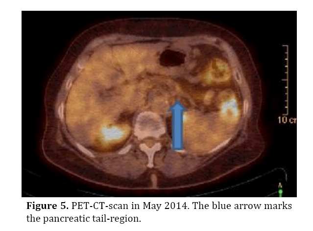 pancreas-blue-arrow-marks