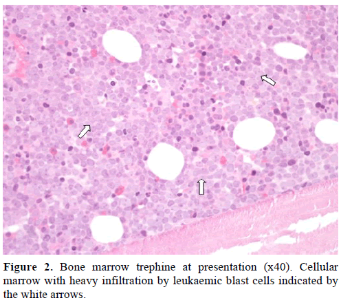 pancreas-bone-marrow-trephine-presentation