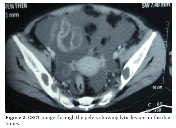 pancreas-bones