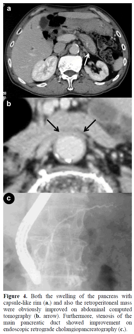 pancreas-both-swelling-pancreas