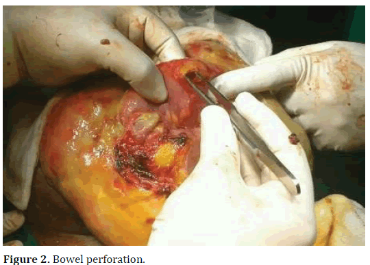 pancreas-bowel-perforation