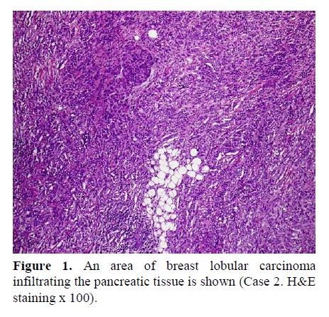 pancreas-breast-lobular-carcinoma