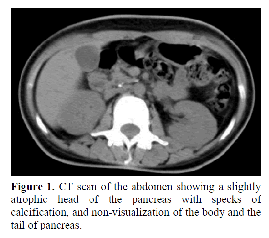 pancreas-calcification-non-visualization