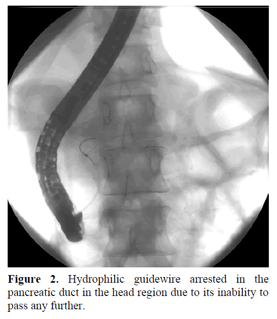 pancreas-calcification-non-visualization