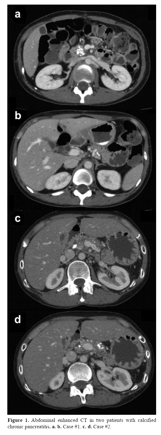 pancreas-calcified-chronic-pancreatitis