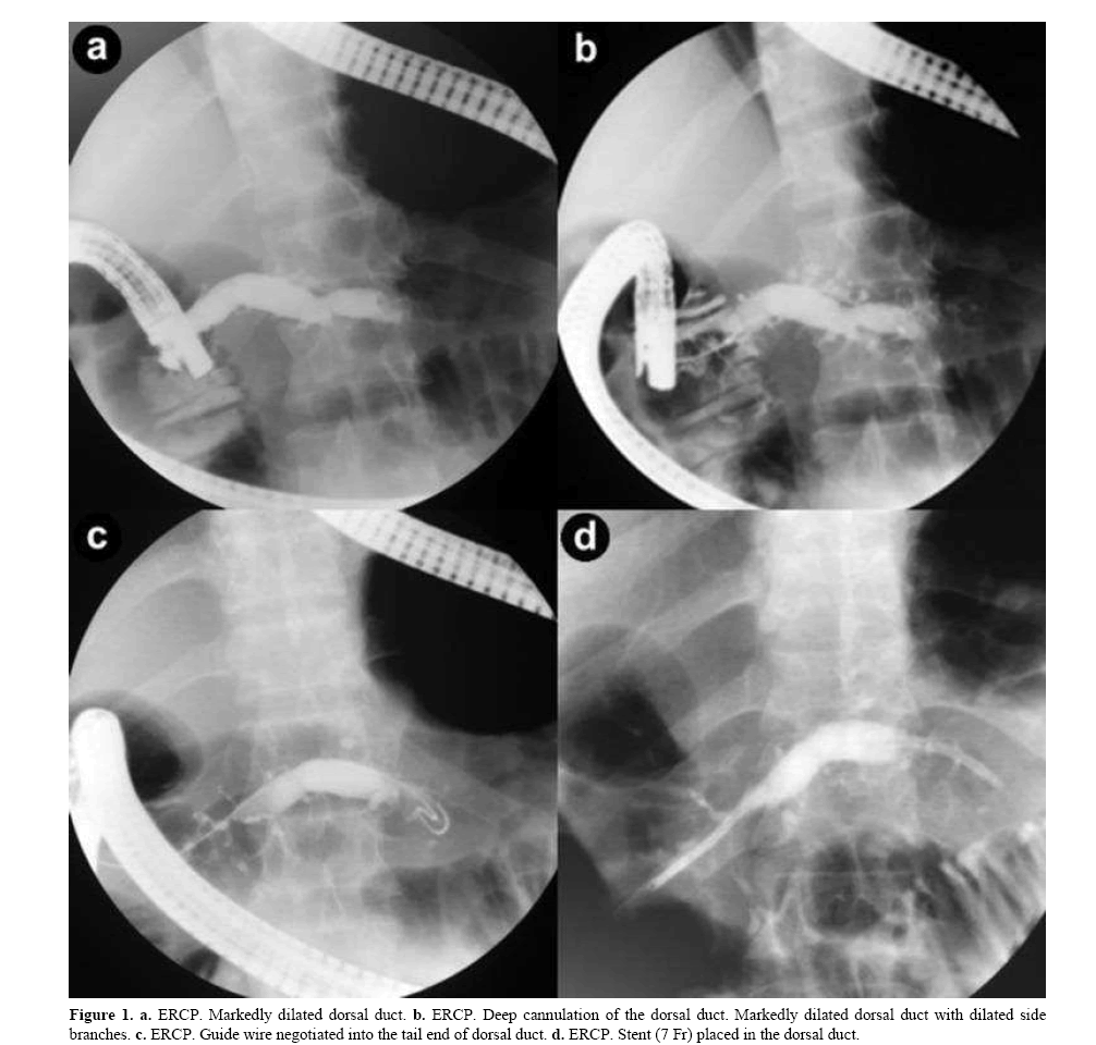 pancreas-cannulation-dorsal-duct