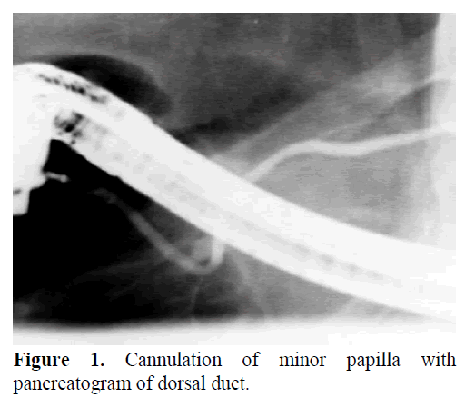 pancreas-cannulation-minor-papilla