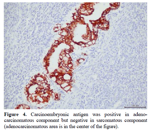 pancreas-carcinoembryonic-antigen-sarcomatous