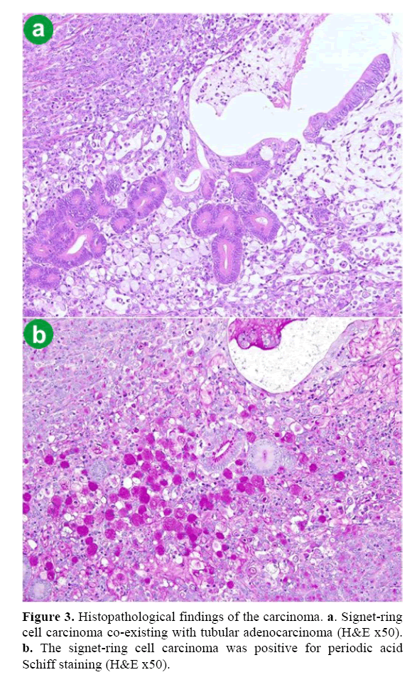 Treatment of gastric signet ring cell carcinoma | Medical Tourism with  MediGlobus: The best treatment around the world