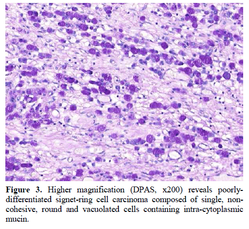 A case of primary ovarian signet-ring cell carcinoma treated with S-1/CDDP  therapy | Journal of Ovarian Research | Full Text