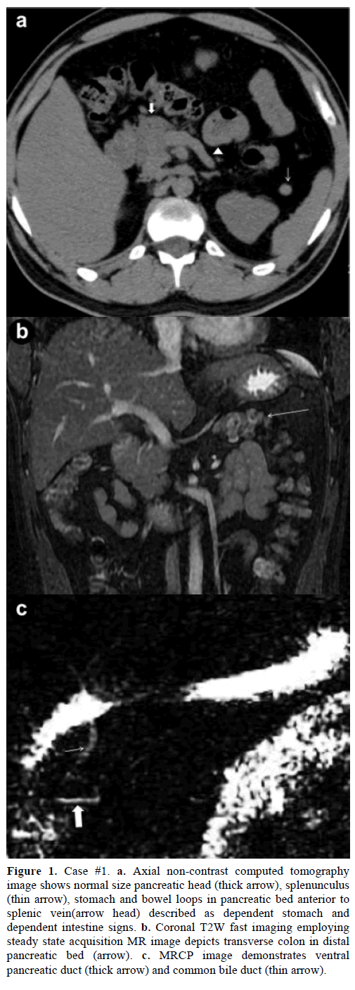 pancreas-case1-axial-non-contrast-computed
