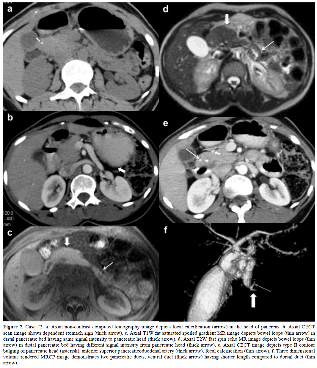 pancreas-case2-axial-non-contrast-computed