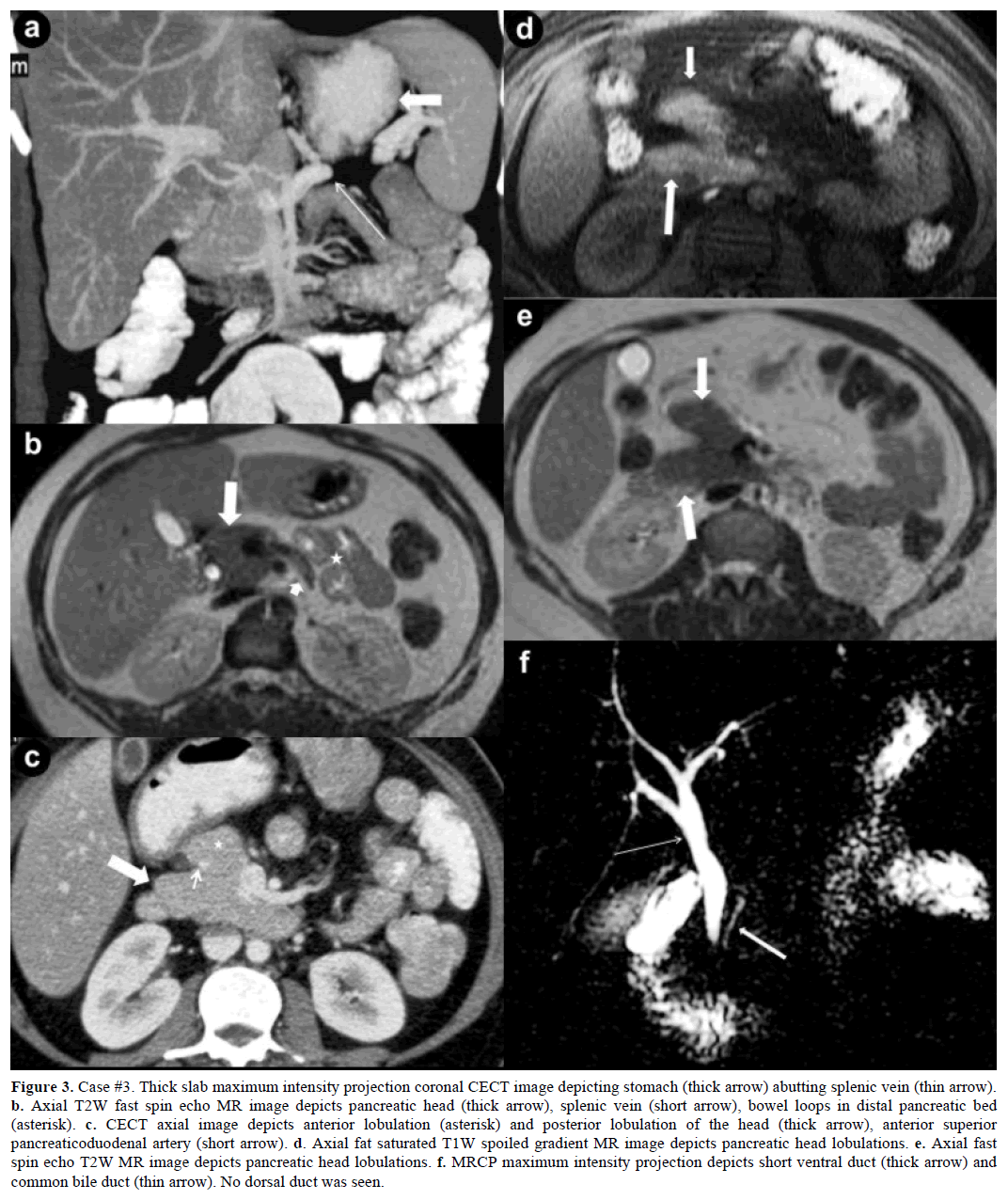 pancreas-case3-thick-slab-maximum-intensity