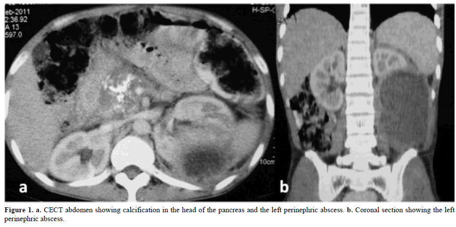 pancreas-cect-abdomen-calcification