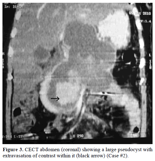 pancreas-cect-abdomen-extravasation