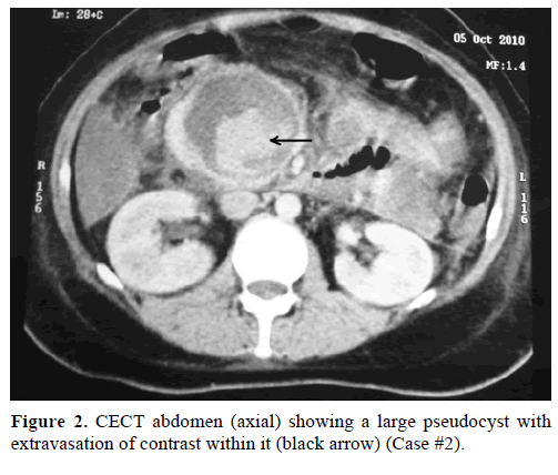 pancreas-cect-abdomen-large-pseudocyst