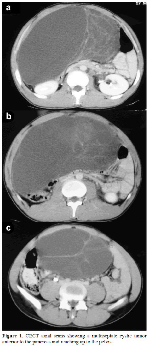 pancreas-cect-axial-scans-multiseptate