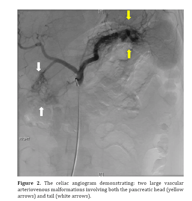 pancreas-celiac-angiogram-demonstrating