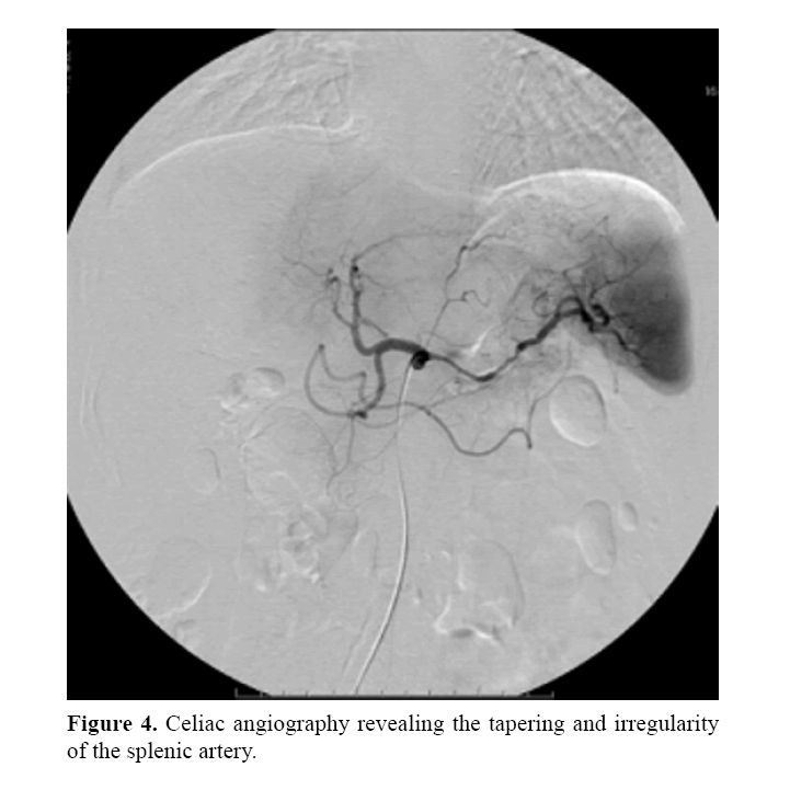 pancreas-celiac-angiography-revealing