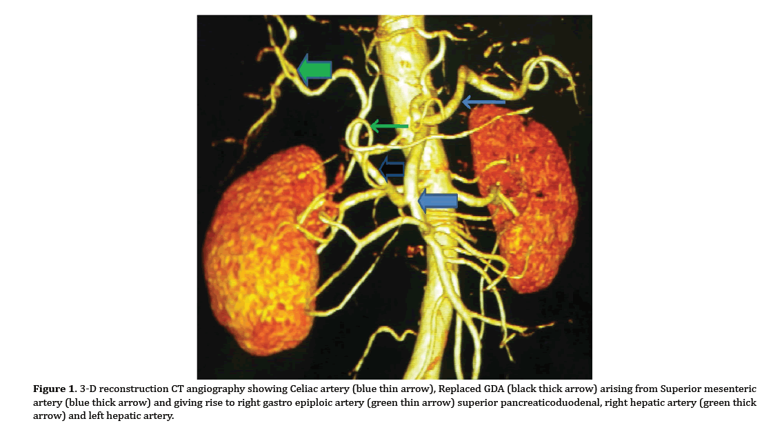 pancreas-celiac-artery