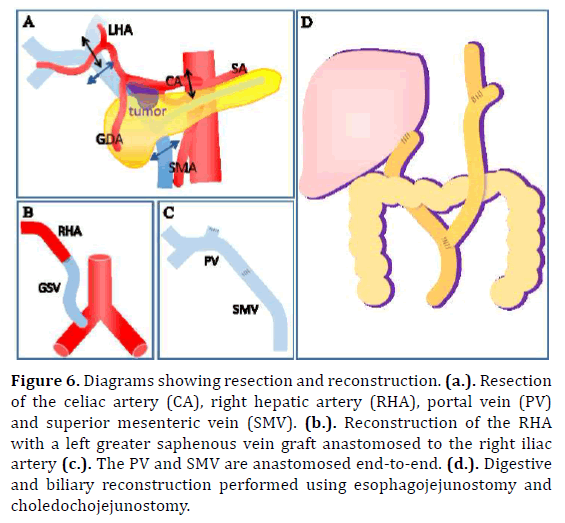 pancreas-celiac-artery-hepatic