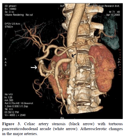 pancreas-celiac-artery-stenosis-tortuous