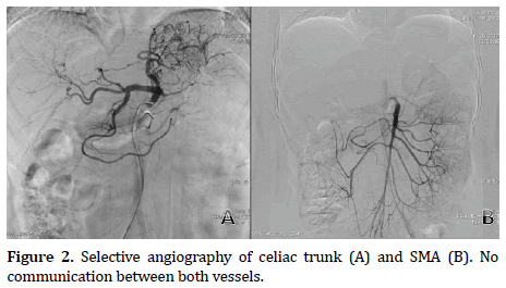 pancreas-celiac-trunk