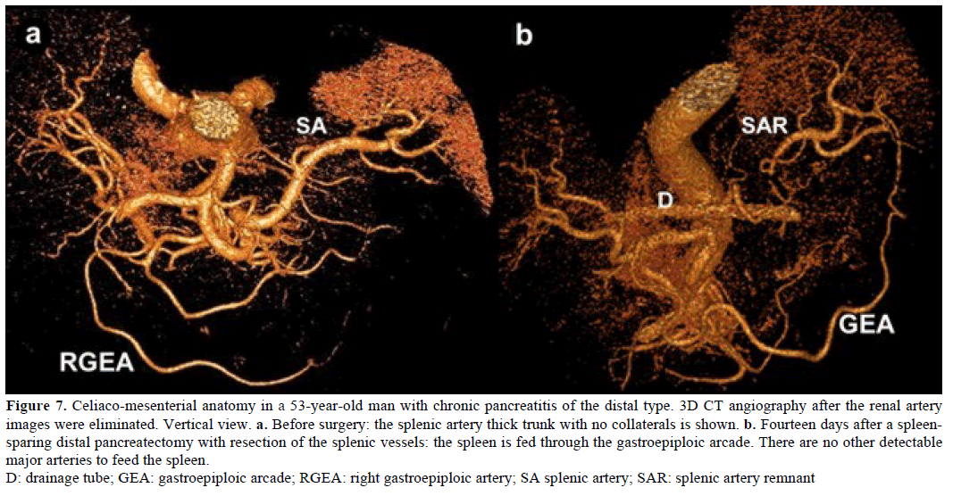 pancreas-celiaco-mesenterial-53-year