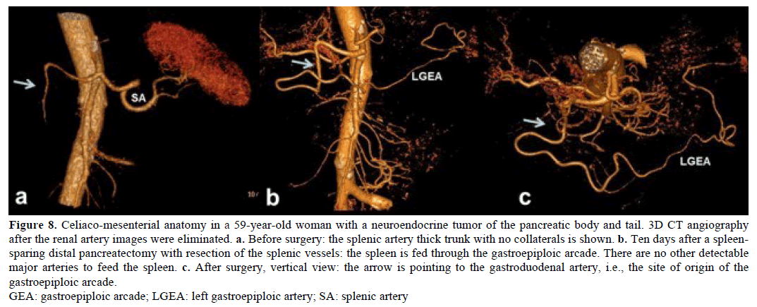 pancreas-celiaco-mesenterial-59-year