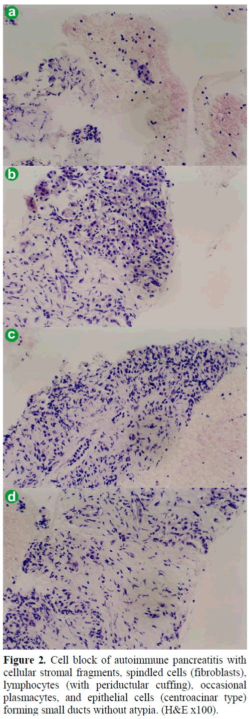 pancreas-cell-block-autoimmune-pancreatitis