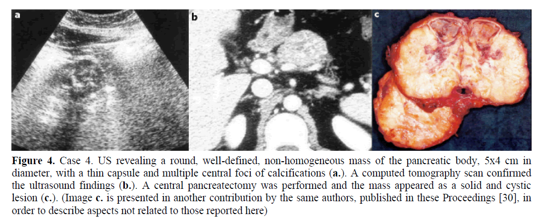 pancreas-central-foci-calcifications