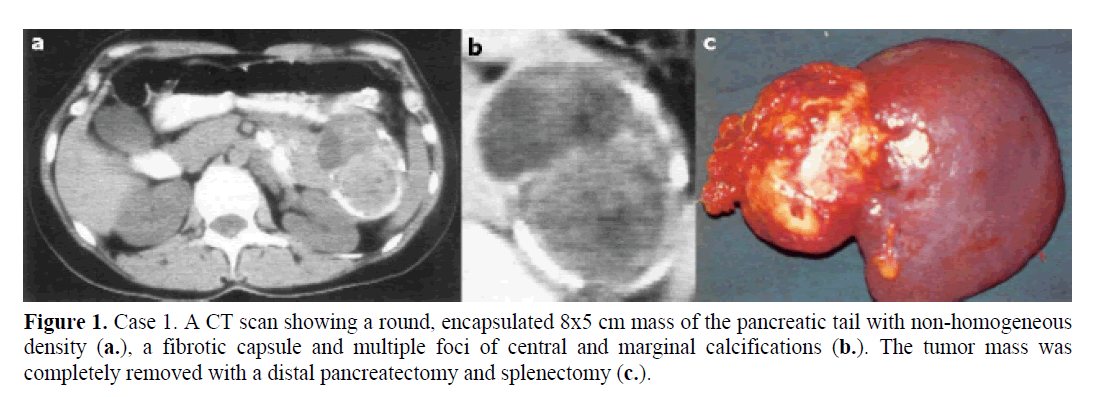 pancreas-central-marginal-calcifications
