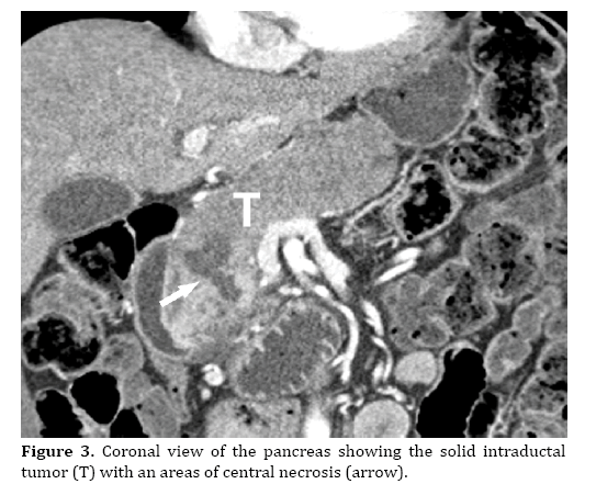 pancreas-central-necrosis